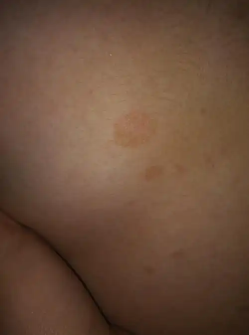 身上起了褐色的斑.先是肚子上有后来胸上也有了.不知道是怎么回