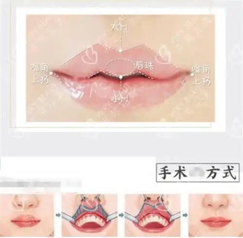 m唇手术示意图