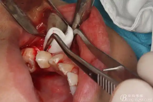 微创法摘除下颌第二前磨牙含牙囊肿