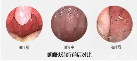 长时间吸烟喝酒以及一些感染性因素引起的急性咽炎治疗不及时
