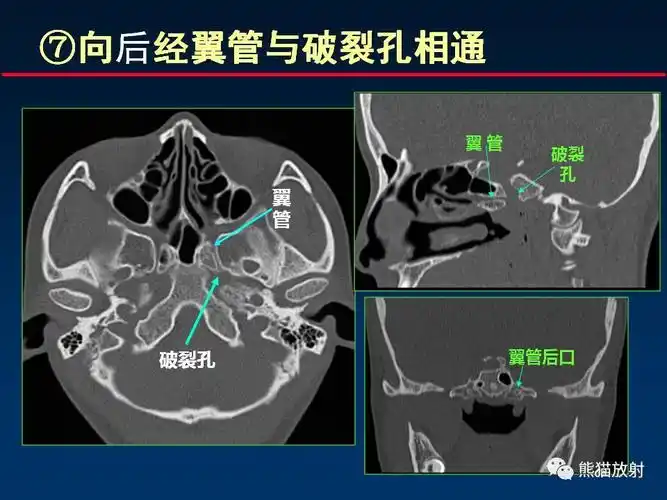 【柳澄讲坛】"翼腭窝解剖"--msct
