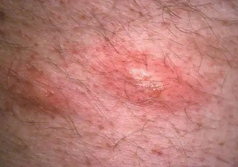 阴囊长硬疙瘩图片生殖器疱疹