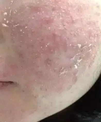 皮肤屏障受损所带来的皮肤问题 - 简书