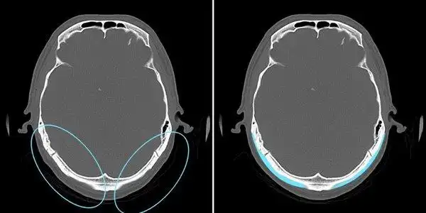 后脑勺不完美怎么办?