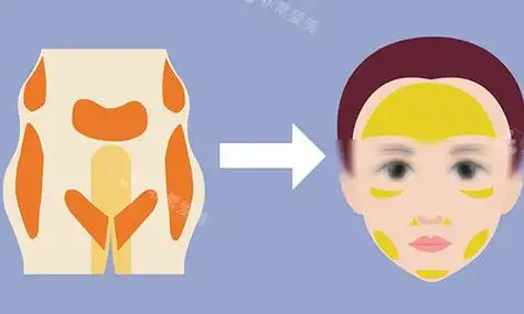 脂肪填充动画图