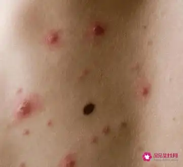 女性得艾滋病的初期症状图片_艾滋病的初期症状_艾滋病初期