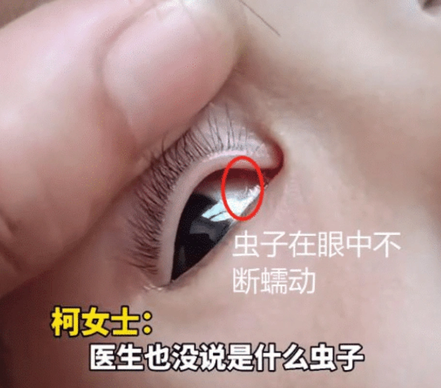 女孩妈妈柯,女士向公众介绍了这一事件的细节,称女儿的异常眼睛早在一