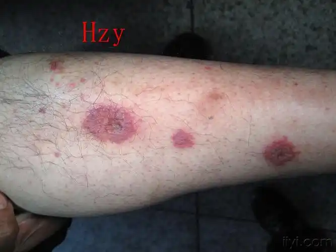 两下肢皮损一个月公布答案变应性血管炎