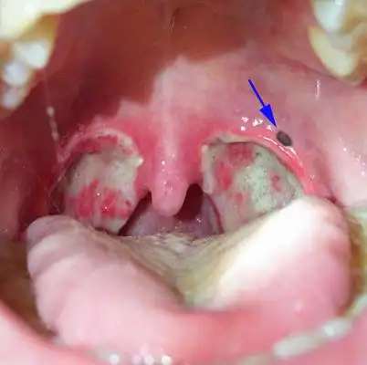 扁桃体结石图片50