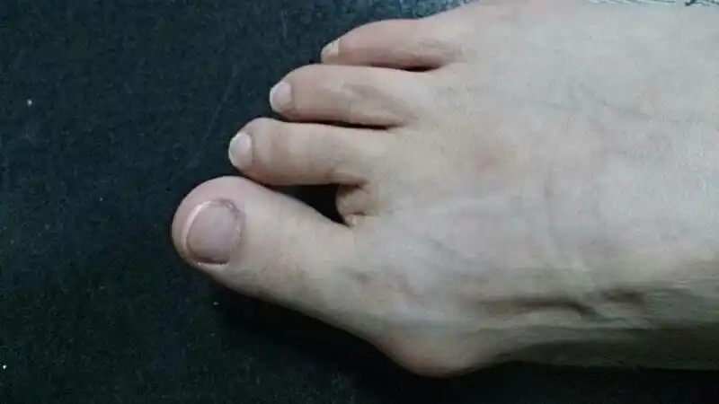 小时候脚趾被绞断了一个,当时去医院治疗过,长大脚就开始变形