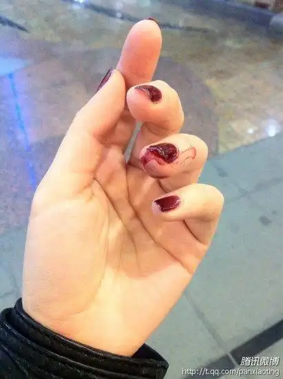 潘晓婷微博曝手被挤伤流血 网友心疼不已(图)