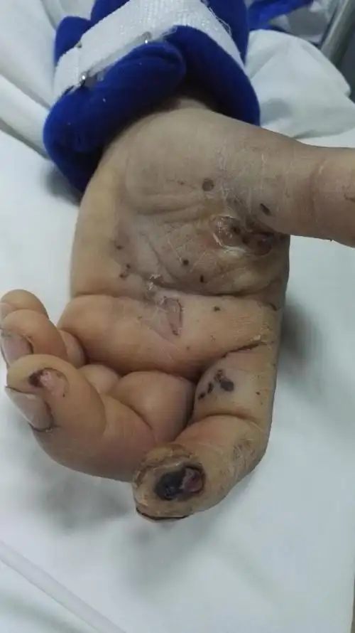 一个多月的日夜守护,我们成功治愈破伤风患者