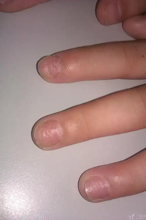 【请教】甲营养不良?有图