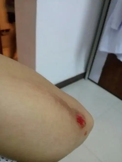 胳膊擦破皮了,,多久擦一次碘酒