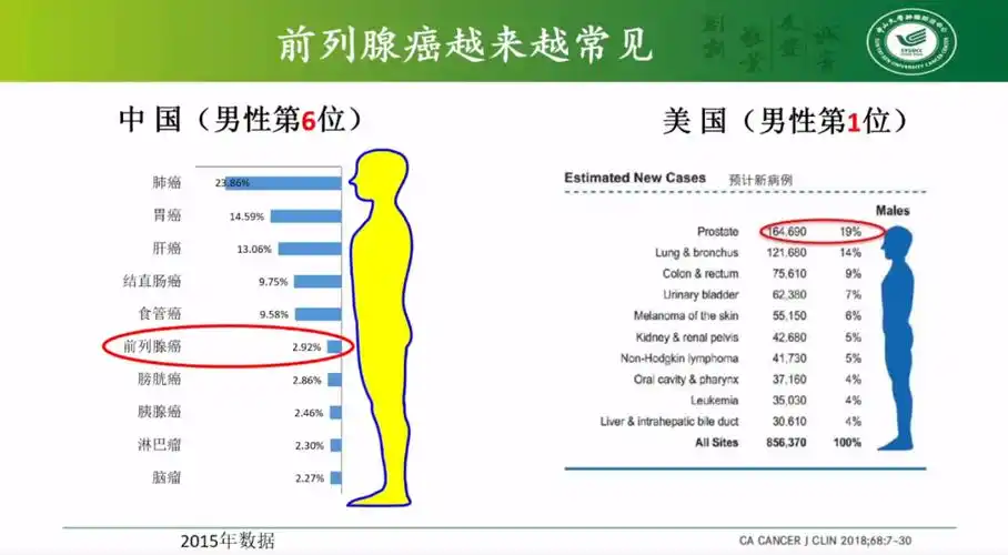 警惕前列腺癌发生风险?