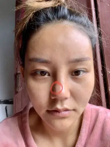 我做的耳软骨加硅胶但是鼻子一侧有鼓包一个月了都还没下去我想知道