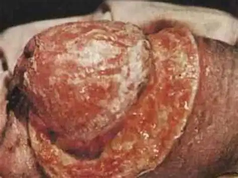 小睾丸症的症状图片