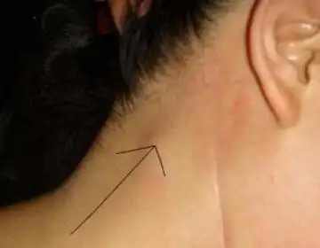 颈部淋巴结肿大怎么办脖子上的小肿块