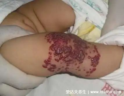 血管瘤最初小红点图片,最开始的症状不起眼(常被误认为朱砂痣)