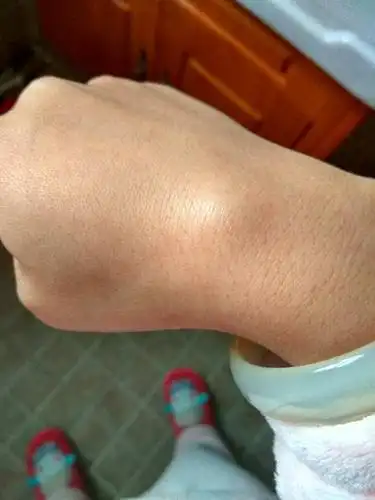 手背上昨天突然长了个硬疙瘩,按起来有点痛,怎么办