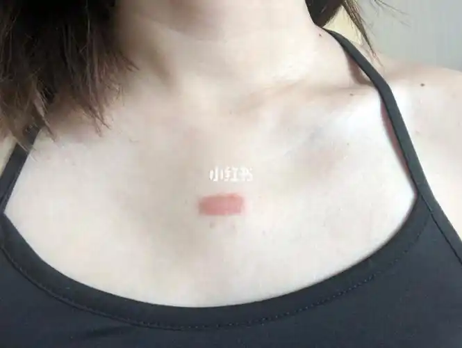 求助有集美和我一样胸前长红色疙瘩的吗