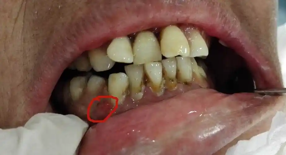 表现为牙龈红肿,疼痛的整整,再进食的时候也可能出现疼痛,出血等症状