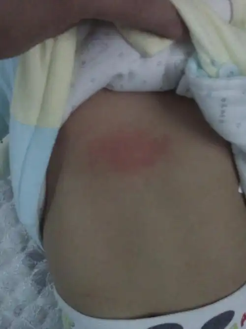 宝宝胸口起个红疙瘩边上一片红 是什么原因