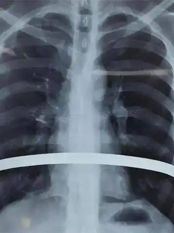 胸廓畸形矫治,重获自信笑容_漏斗_手术_治疗