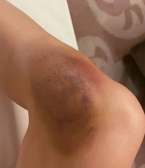 张馨予晒受伤照 双腿大片淤青惹人怜