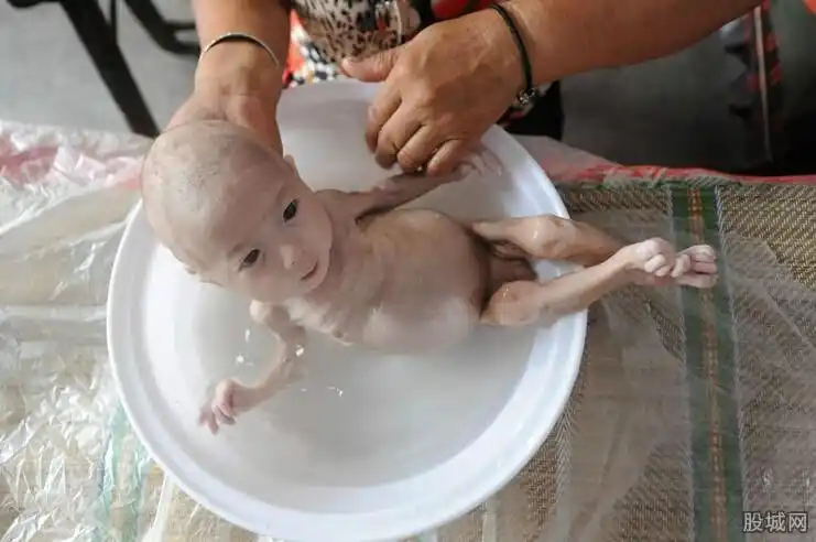 山西一农家生出"无肛男婴"酷似外星人