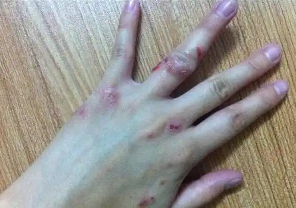 汗疱疹图片和症状图片汗疱疹用什么药膏能治好