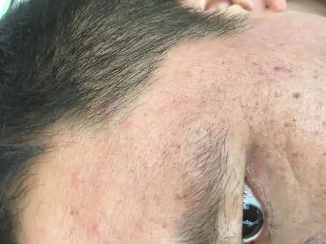 男性35岁全身散发水疱1天原创