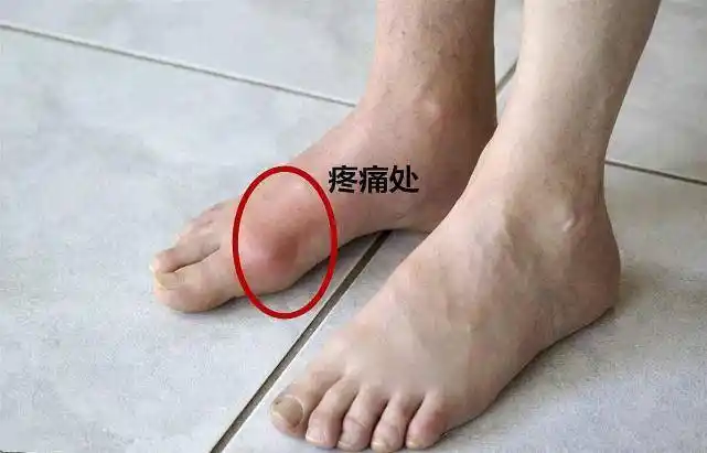 痛风发作时,最常侵犯拇指关节和大脚趾关节,其次比较常见的是脚踝,脚