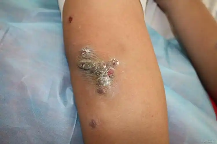 肘部膝盖部对称性丘疱疹不痒