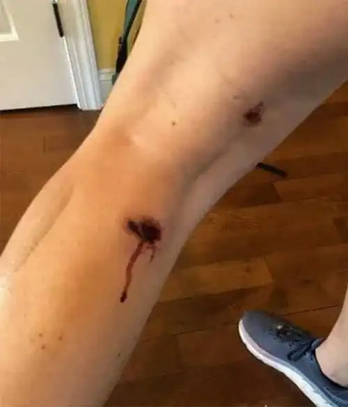 俄罗斯卫星网记者被橡皮子弹打伤后身体留下的伤口 图自卫星网