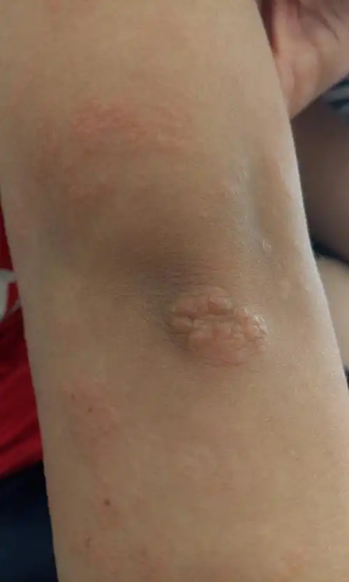 六岁孩子身上长些小疙瘩,是什么?出汗还痒