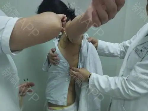 新氧- 思思杰杰 | 胸部 | 美体塑形 | 去副乳 | 吸脂去副乳 | 吸脂瘦