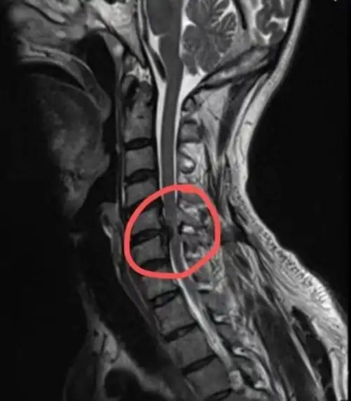脊髓型颈椎病如何快速识别,抓住这几点很重要!