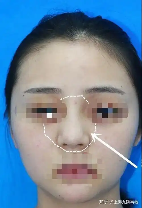 为什么注射隆鼻会导致鼻背越来越宽