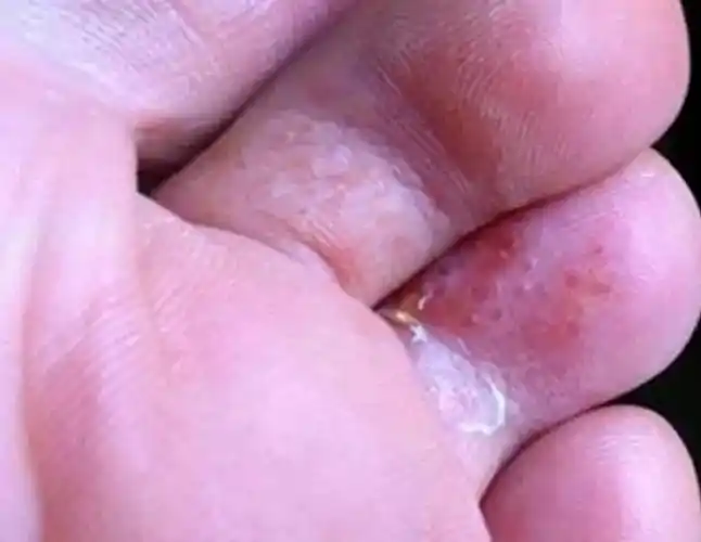 脚气湿疹这两者有什么区别