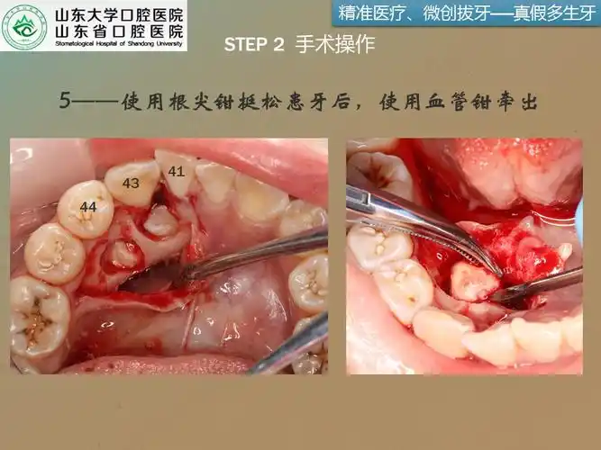 疑难复杂牙拔除系列3右下颌前磨牙根方两颗多生牙