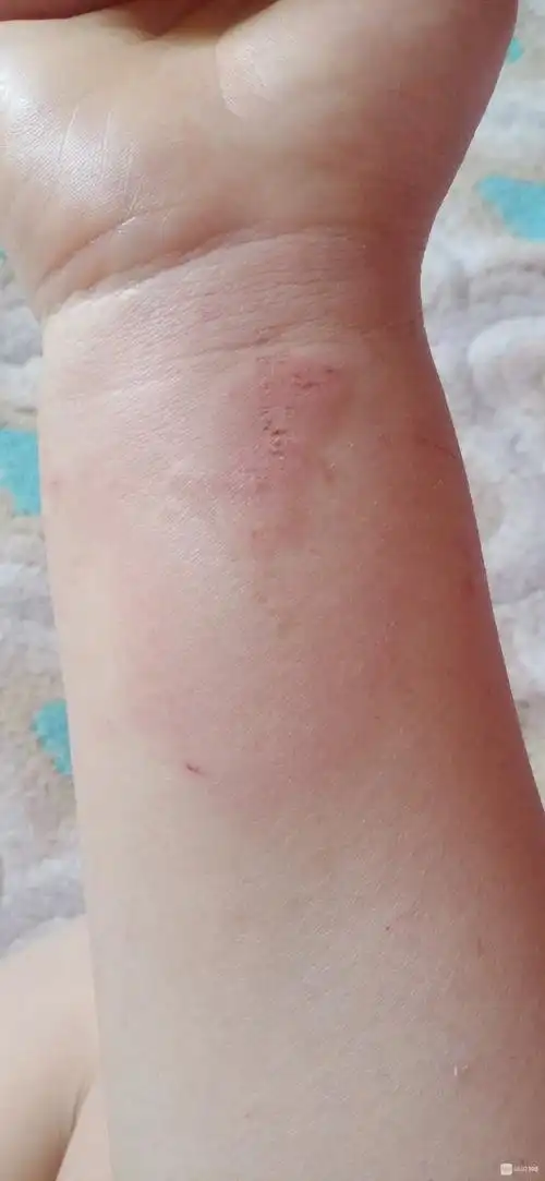 被蚂蚁咬了肿起来,有什么