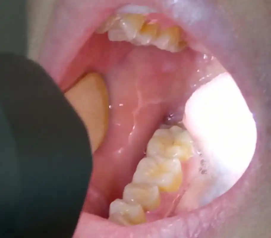 昨天门诊有位患者说自己口腔两颊有白色的条纹,不疼不痒,有一段时间