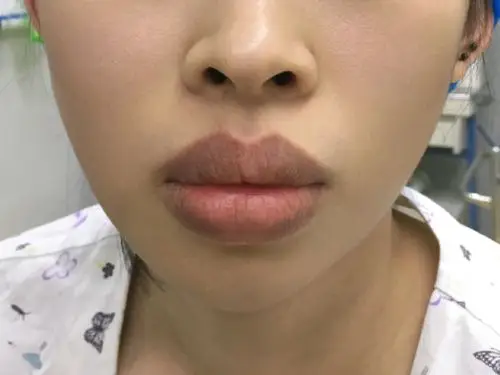 元宝唇唇综合案例分享#元宝唇