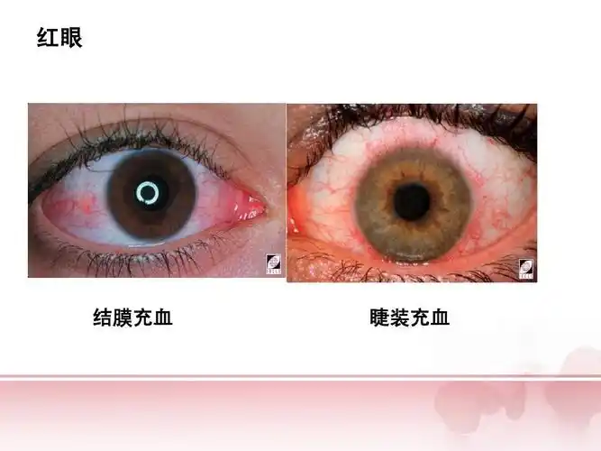 红眼 结膜充血充血 睫装充血充血