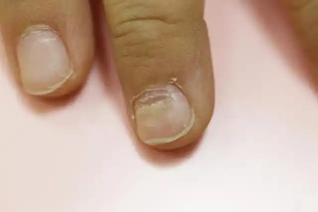 博氏线严重吗_博氏线