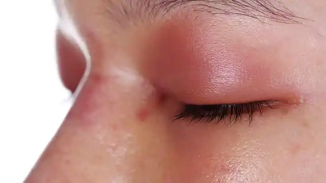 二,目赤肿痛 对于眼结膜炎,眼睛红肿疼痛者,通过服用桑叶茶来缓解症状