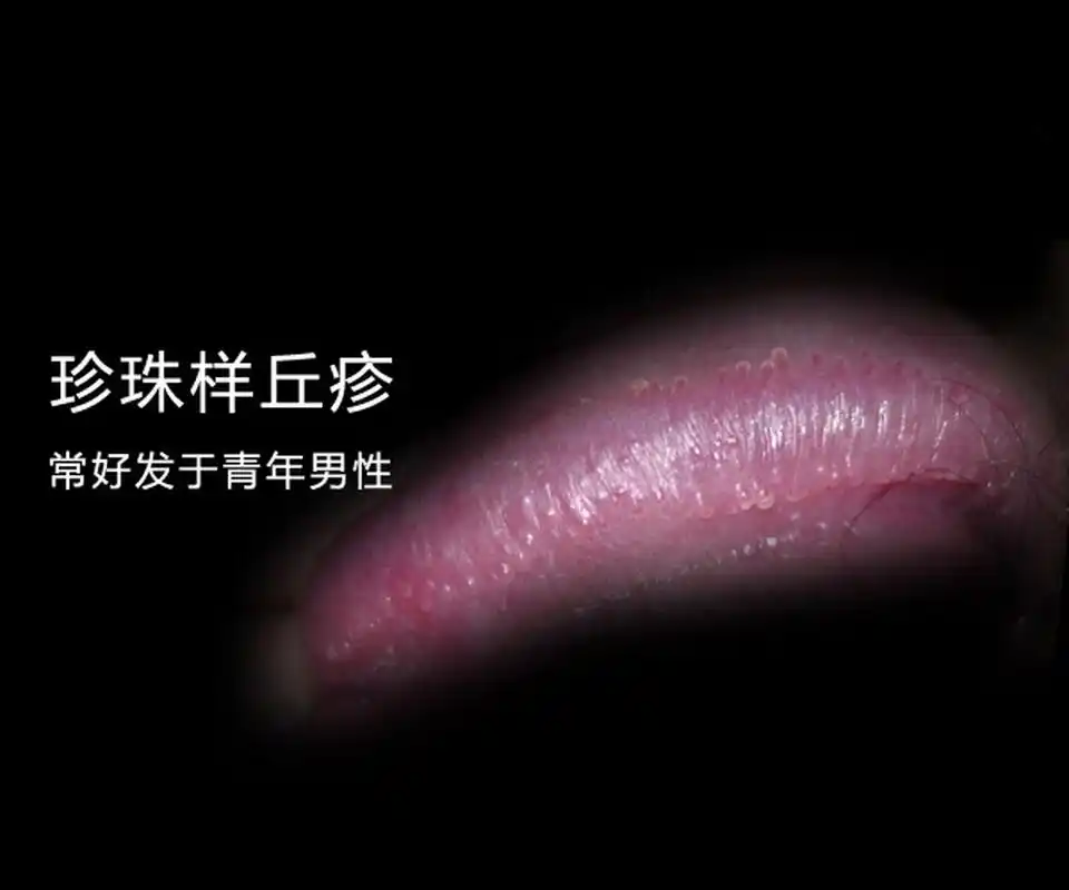 是指珍珠状阴茎丘疹,通常情况下,珍珠状阴茎丘疹不属于性病,因此男性