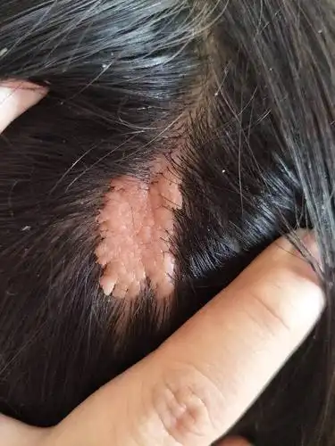 求助医生,帮我看看头上这个到底是什么东西?(觉得恶心勿点)