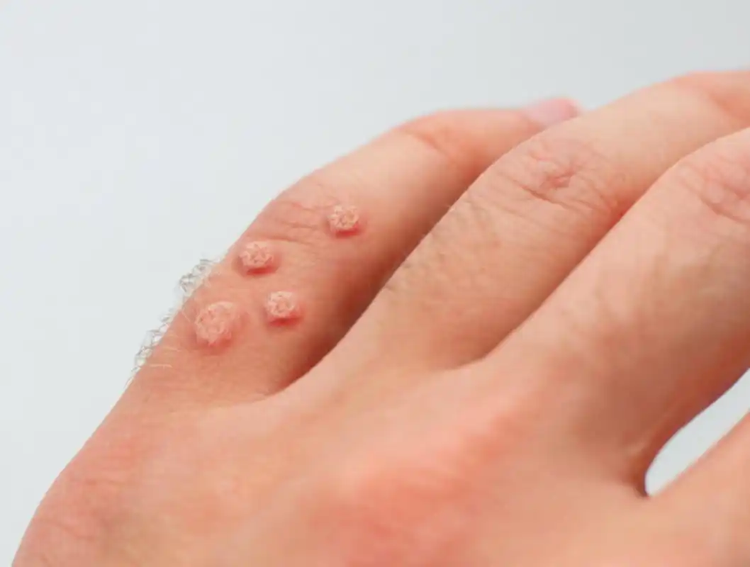 如果你手背上长了寻常疣已经有两个月了,我建议你尽快去就近的医院